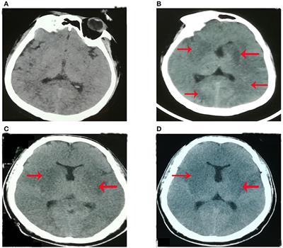 A Case of Human Viral Encephalitis Caused by Pseudorabies Virus Infection in China